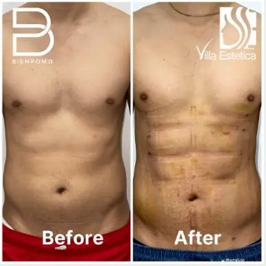 Liposuction before and after patient result