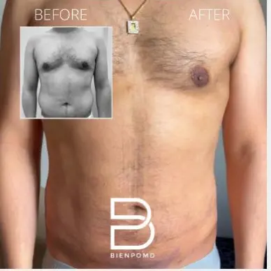 Two-week transformation after Chest Liposuction.