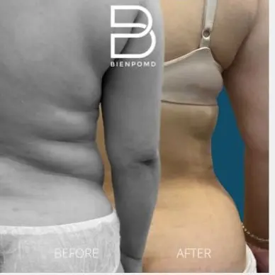 Two-week transformation after Abdominal Liposuction.