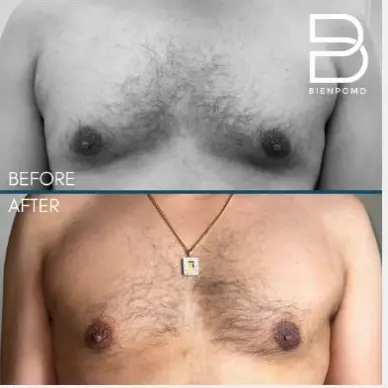 Two-week transformation after Chest Liposuction.
