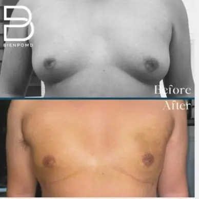 Two-week transformation after Chest Liposuction.