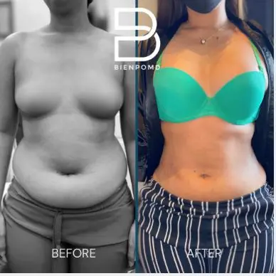 One-month transformation after Abdominal Liposuction.