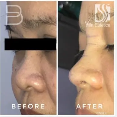 Rhinoplasty before and after patient result