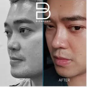 One month after ePTFE Implant Rhinoplasty.