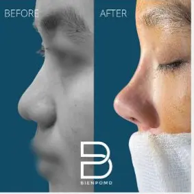One-week transformation after Gore-Tex Implant Rhinoplasty.
