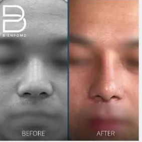 One-month transformation after Gore-Tex Implant Rhinoplasty.