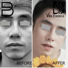 Immediate transformation after Gore-Tex Implant Rhinoplasty.