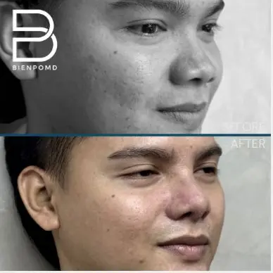 One-week transformation after Acellular Dermal Matrix and irradiated-rib Rhinoplasty.