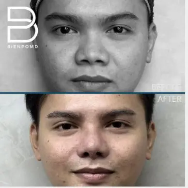 One-week transformation after Acellular Dermal Matrix and irradiated-rib Rhinoplasty.