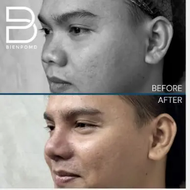 One-week transformation after Gore-Tex Implant Rhinoplasty.