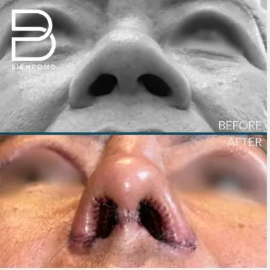 One-week transformation after Gore-Tex Implant Rhinoplasty.