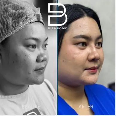 One-week transformation after Gore-Tex Implant Rhinoplasty.