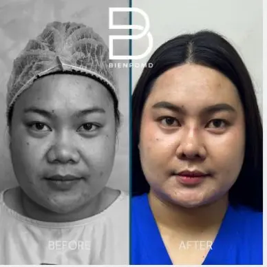 Two-week transformation after Gore-Tex Implant Rhinoplasty with irradiated rib and conchal-cartilage tipplasty.