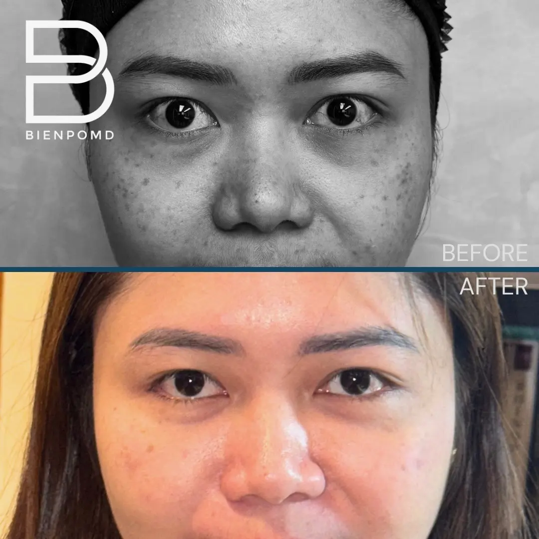 One-week transformation after Under Eye Fat Graft Transfer.