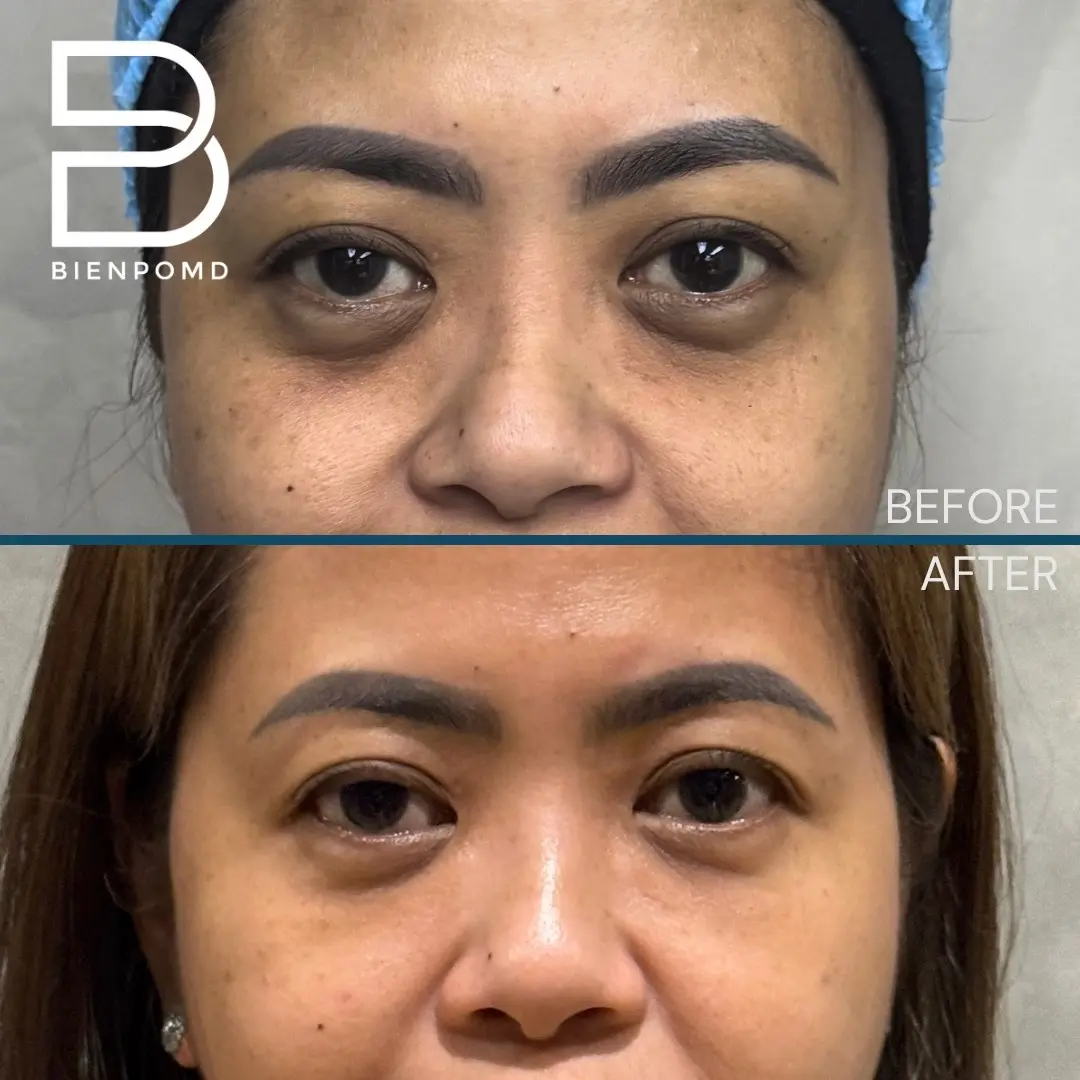 One-week transformation after Under Eye Fat Graft Transfer.