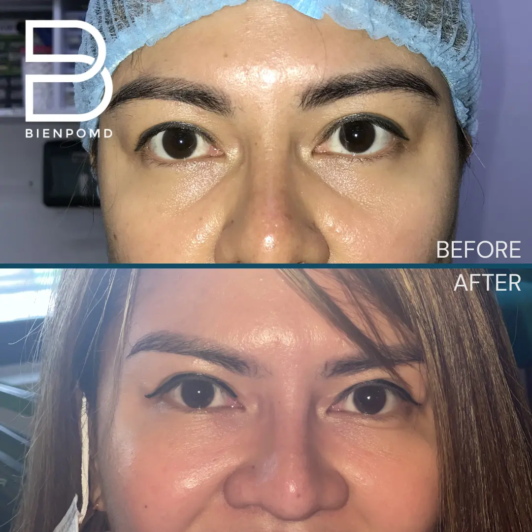 One-week transformation after Under Eye Fat Graft Transfer.