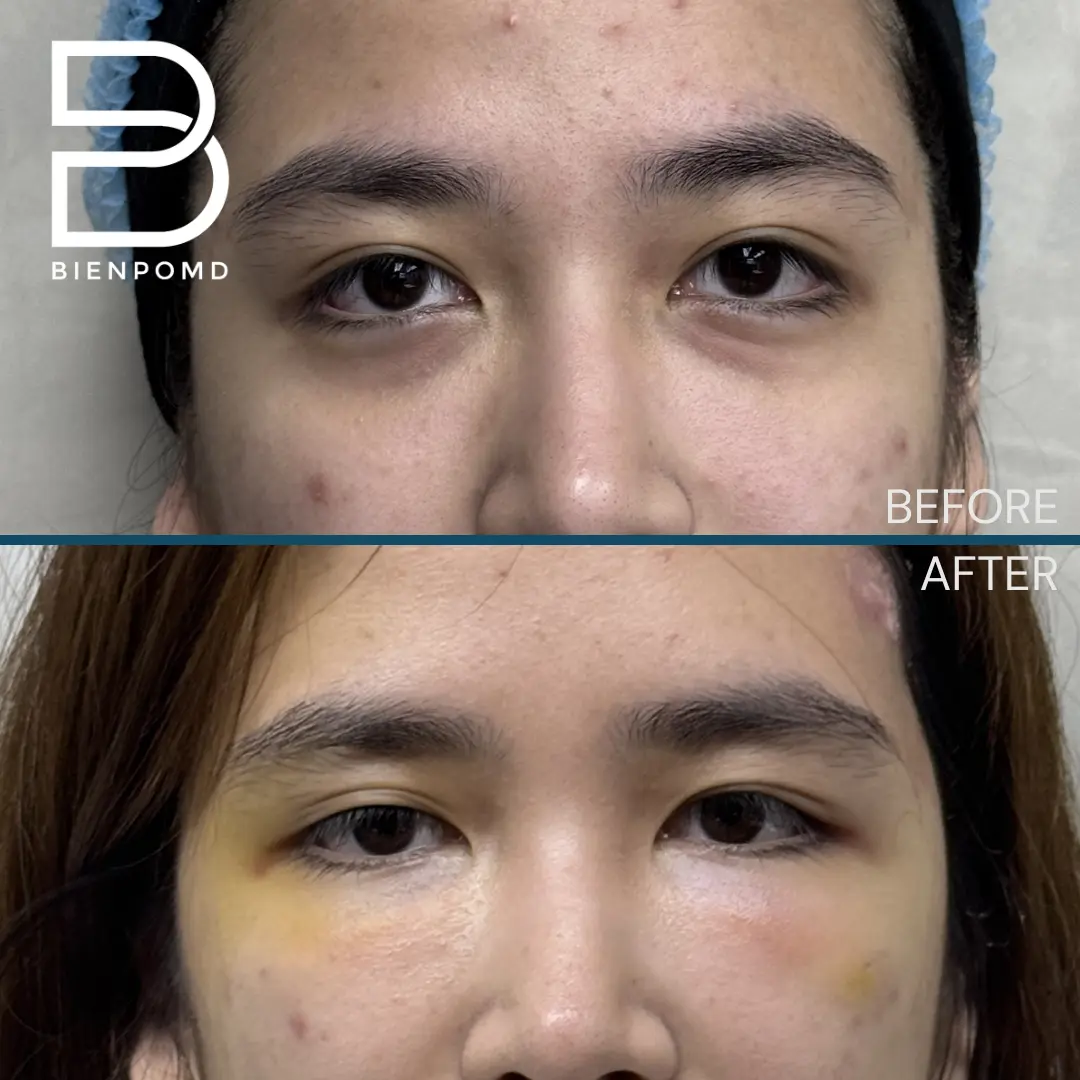 One-week transformation after Under Eye Fat Graft Transfer.