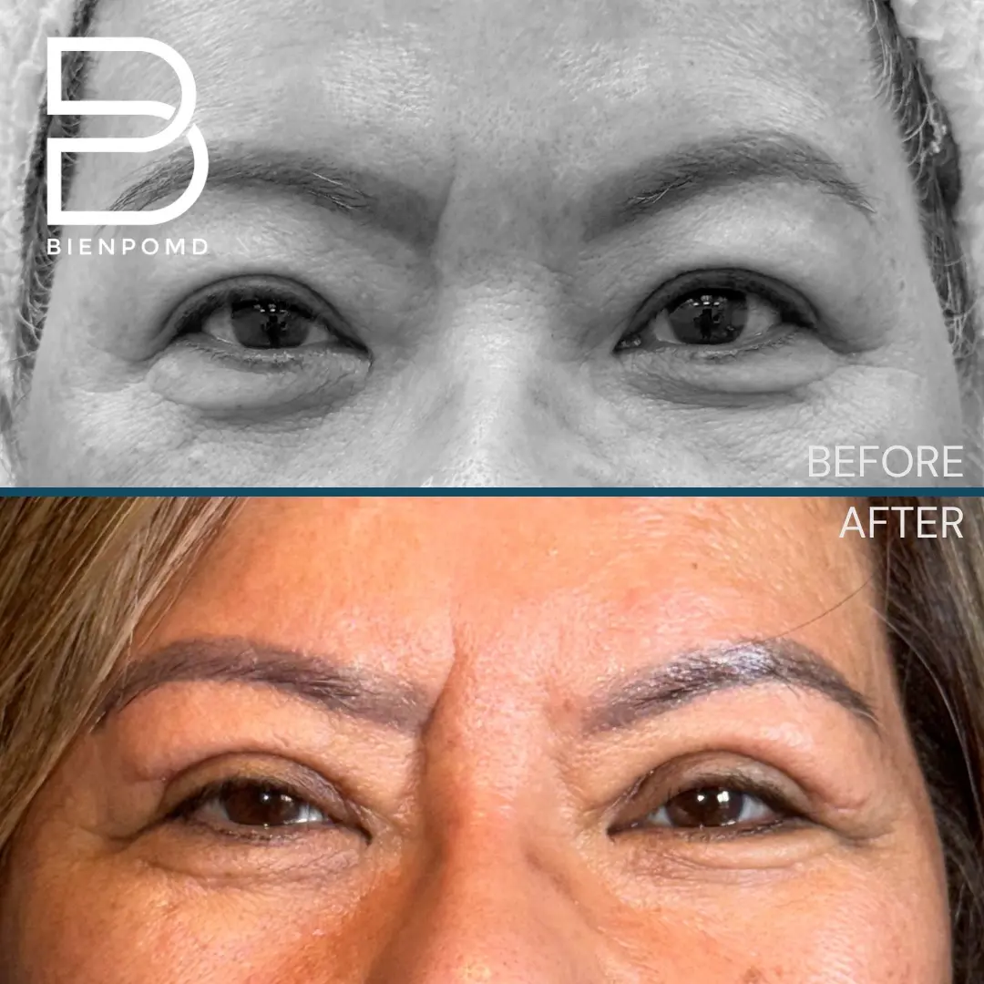 Upper Blepharoplasty before and after patient result