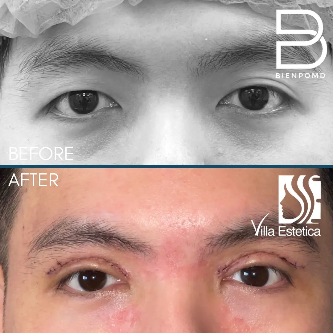 One-week transformation after Upper Blepharoplasty.