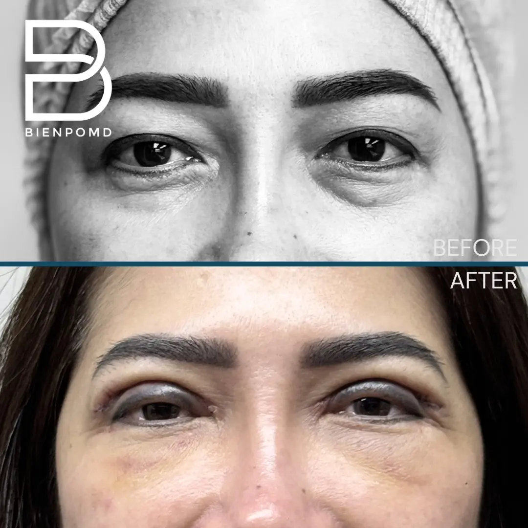 One-week transformation after Upper Blepharoplasty.