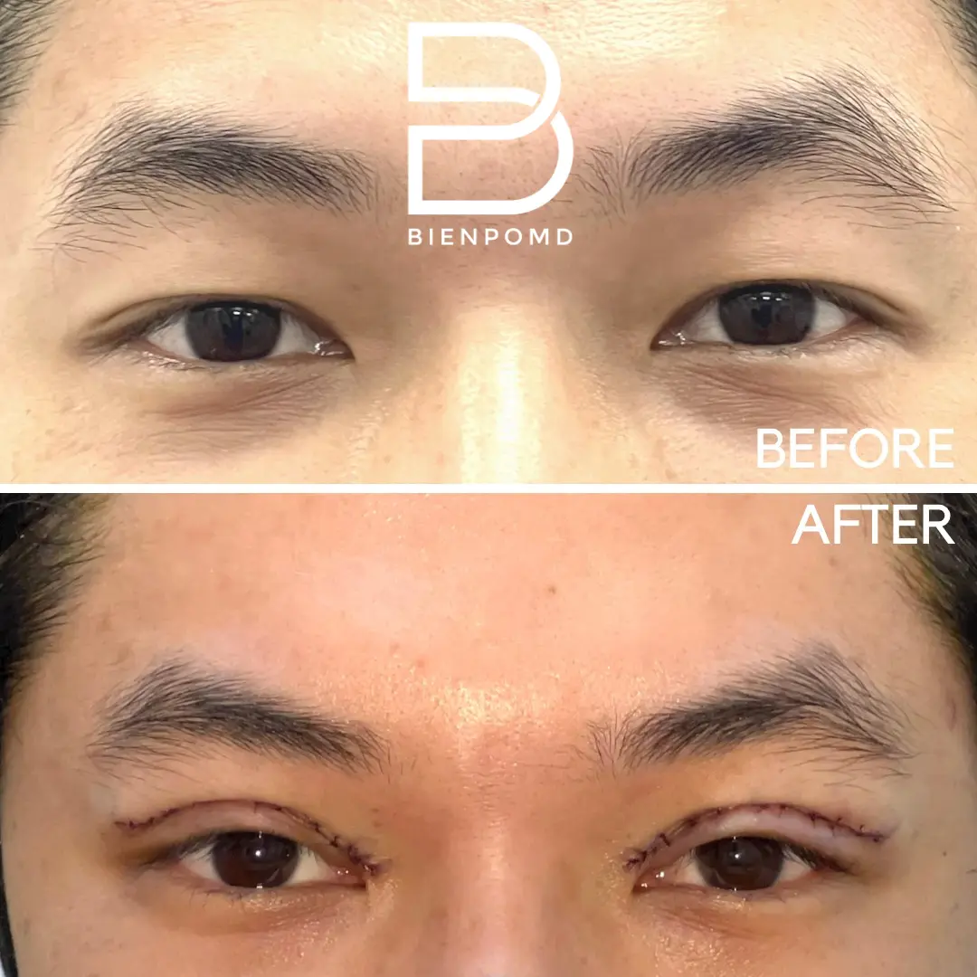 One-week transformation after Upper Blepharoplasty.