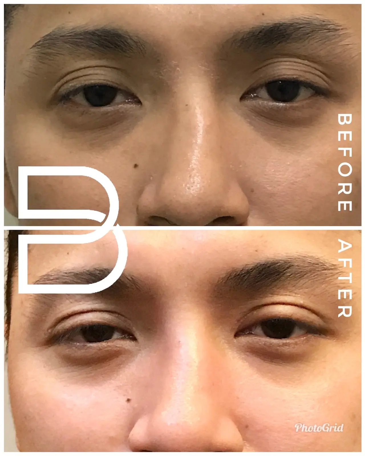 One-month transformation after Upper Blepharoplasty.