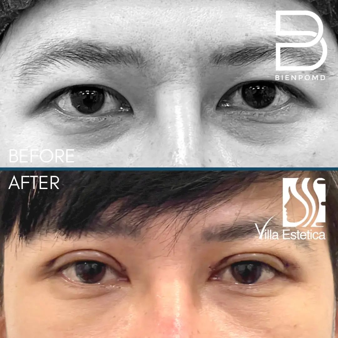 One-week transformation after Upper Blepharoplasty.