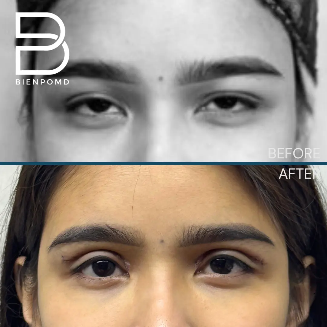 One-week transformation after Upper Blepharoplasty.