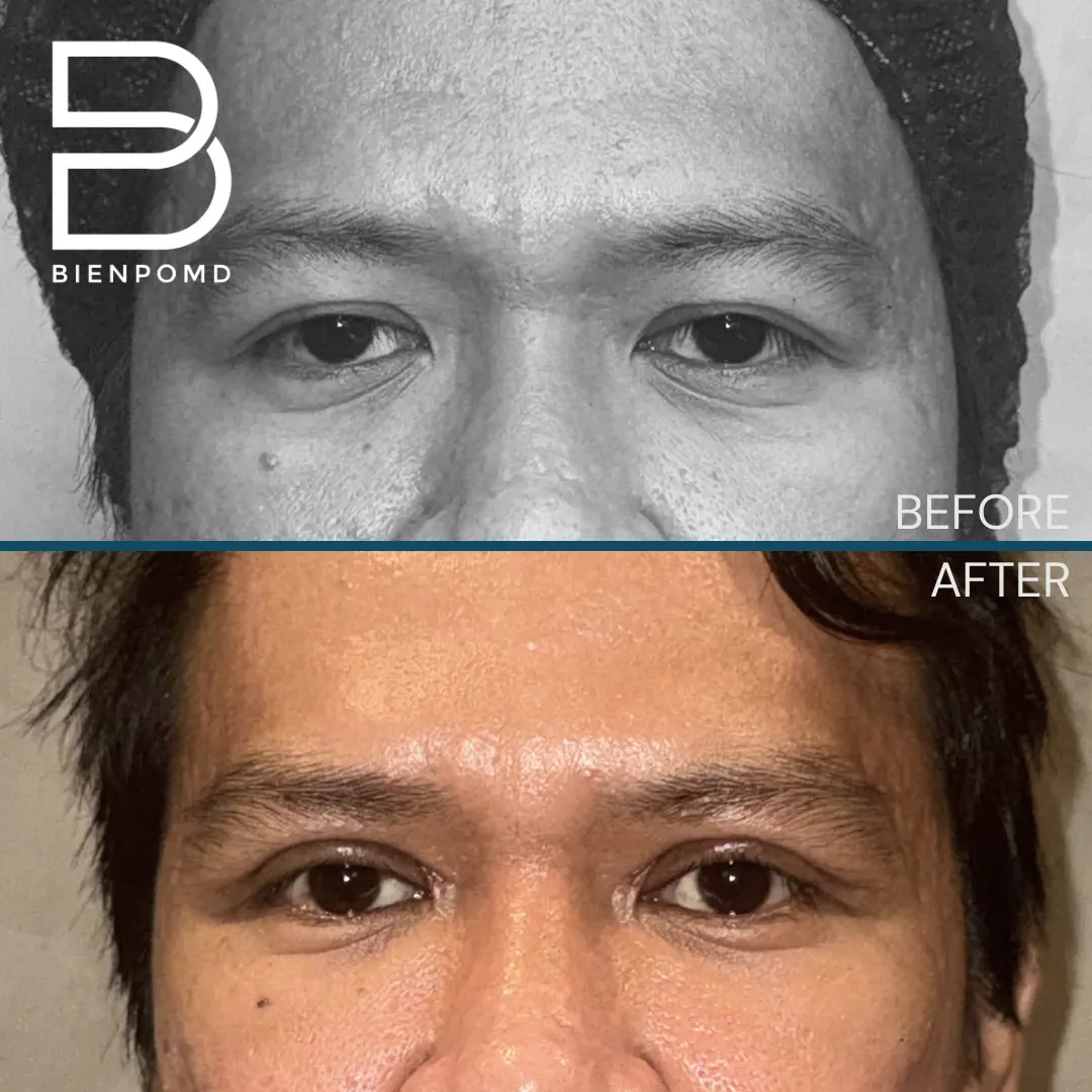 Two-week transformation after Upper Blepharoplasty and under-eye fat graft transfer.