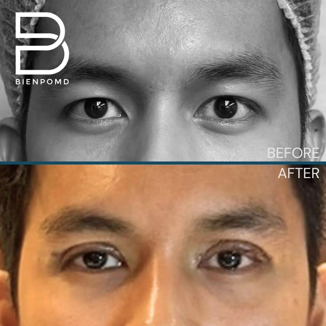 Male Upper Blepharoplasty immediately after surgery.
