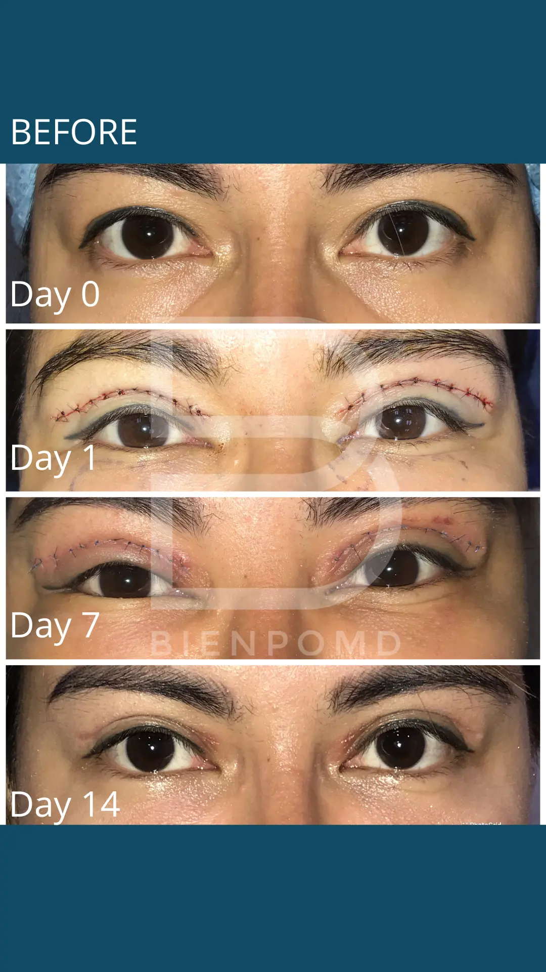 Upper Blepharoplasty healing journey from Day 0 to Day 14.