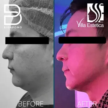 One month transformation after V-Line Liposuction.