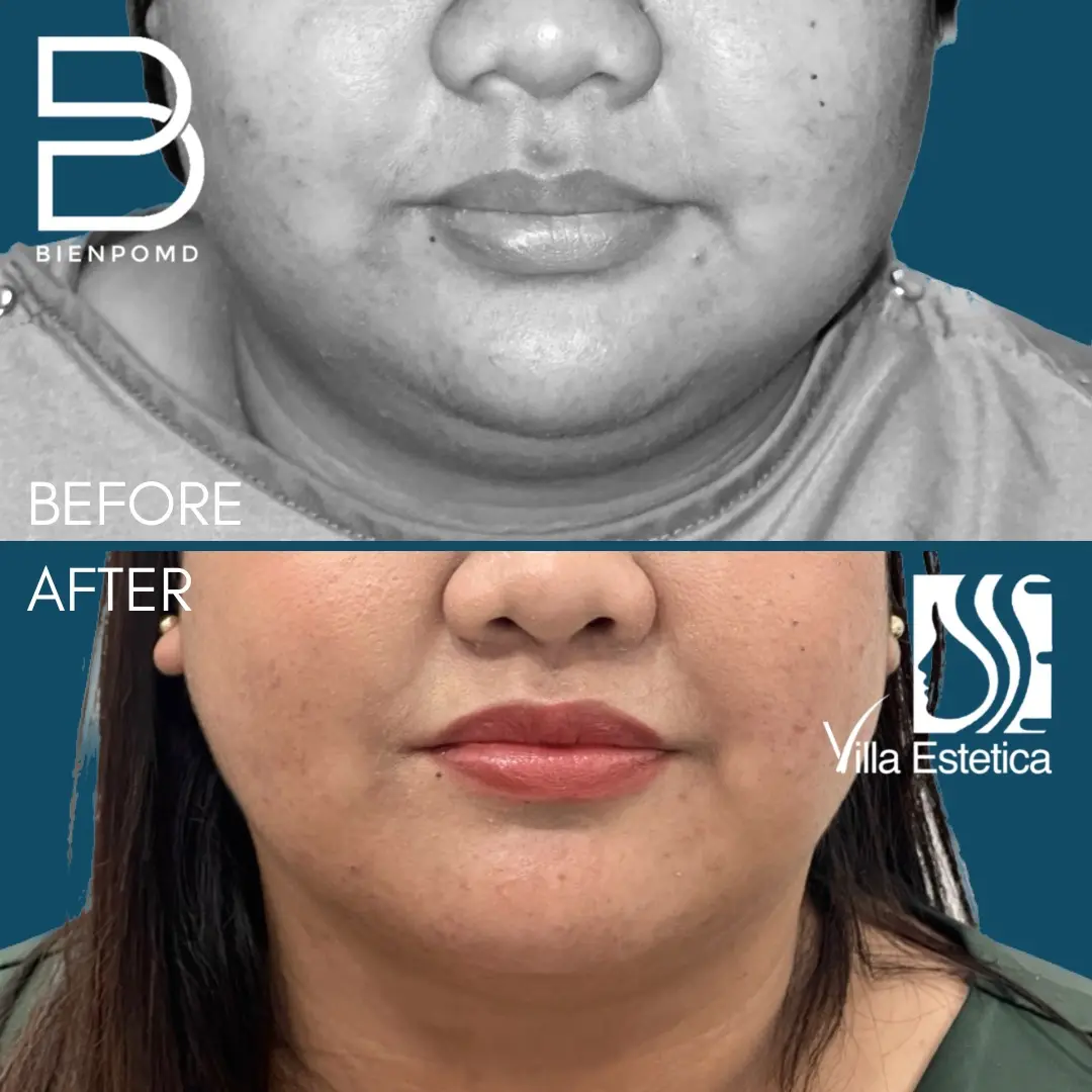 Two weeks transformation after V-Line Liposuction.