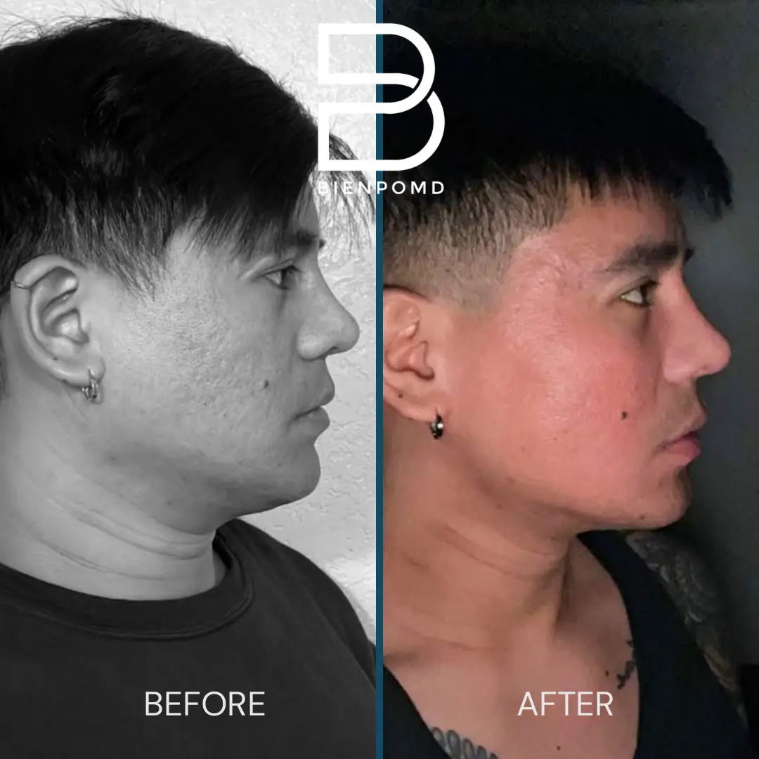 Two weeks transformation after V-Line Liposuction.