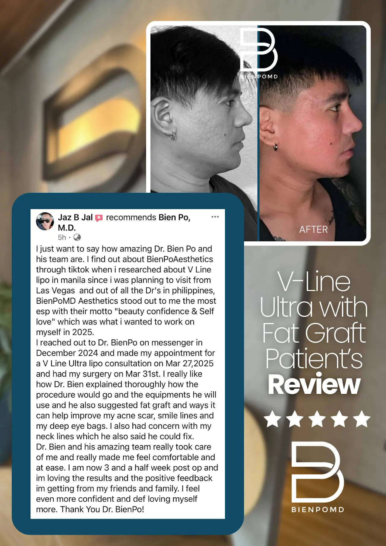 V-Line ULTRA with fat graft patient review about healing and treatment experience