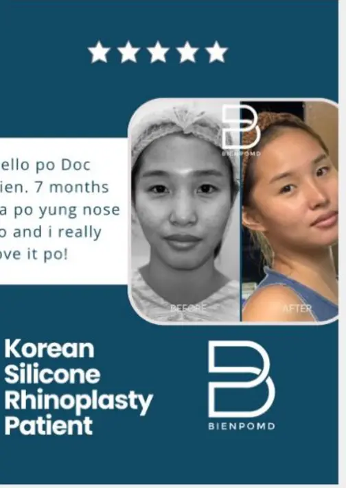 Korean silicone Rhinoplasty patient review with a seven-month healing update
