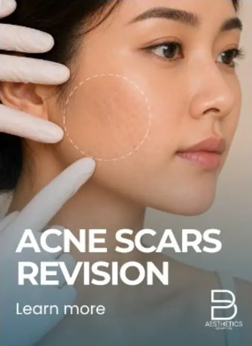 Acne Scar Revision treatment artwork from BienPoMD